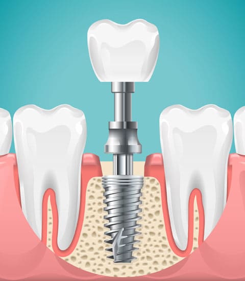 img-Benefits-Of-Dental-Implants