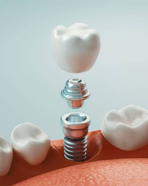 img-Dental-Implant-Process