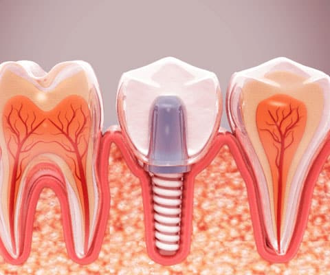 img-What-Are-Dental-Implants