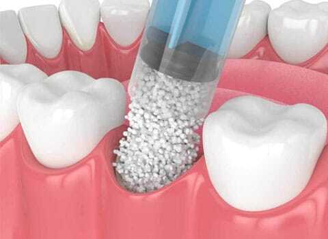 img-What-Is-Bone-Grafting