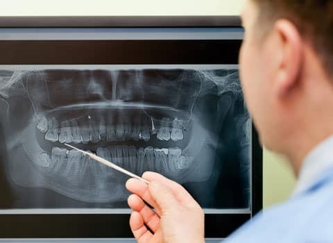 img-Why-Is-Bone-Grafting